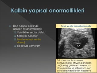  Dört odacık kesitinde
görülen ek anormallikler:
 Ventriküler septal defekt
 Kardiyak tümörler
 Total anormal venöz
drenaj
 Sol atriyal izomerizm
Pulmoner venlerin normal
pozisyonda sol atriyuma arkadan
bağlandığı görülmez. Normal sol
atriyum şeklini ve sol atriyum-inen
aorta arasındaki artan mesafeye
Total Venöz drenaj anomalisi
 