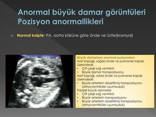  Normal kalpte: PA, aorta köküne göre önde ve üstte(kraniyal)
Büyük damarların anormal pozisyonları:
Aort kapağı, sağda önde ve pulmoner kapak
üzerindedir.
• Çift çıkışlı sağ ventrikül
• Büyük damar transpozisyonu
Aort kapağı, solda önde ve pulmoner kapak
üzerindedir.
• Büyük arterlerin düzeltilmiş transpozisyonu
(atriyoventriküler uyumsuzluk)
Paralel büyük damarlar
• Çift çıkışlı sağ ventrikül
• Büyük arterlerin transpozisyonu
• Büyük arterlerin düzeltilmiş transpozisyonu
(atriyoventriküler uyumsuzluk)
 