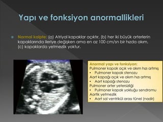  Normal kalpte: (a) Atriyal kapaklar açıktır, (b) her iki büyük arterlerin
kapaklarında ileriye değişken ama en az 100 cm/sn bir hızda akım,
(c) kapaklarda yetmezlik yoktur.
Anormal yapı ve fonksiyon:
Pulmoner kapak açık ve akım hızı artmış
• Pulmoner kapak stenozu
Aort kapağı açık ve akım hızı artmış
• Aort kapağı stenozu
Pulmoner arter yetersizliği
• Pulmoner kapak yokluğu sendromu
Aortik yetmezlik
• Aort sol ventrikül arası tünel (nadir)
 