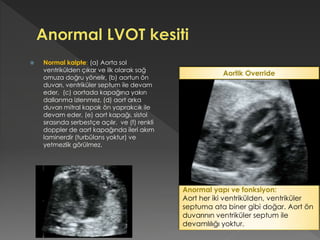 Normal kalpte: (a) Aorta sol
ventrikülden çıkar ve ilk olarak sağ
omuza doğru yönelir, (b) aortun ön
duvarı, ventriküler septum ile devam
eder, (c) aortada kapağına yakın
dallanma izlenmez, (d) aort arka
duvarı mitral kapak ön yaprakcık ile
devam eder, (e) aort kapağı, sistol
sırasında serbestçe açılır, ve (f) renkli
doppler de aort kapağında ileri akım
laminerdir (turbülans yoktur) ve
yetmezlik görülmez.
Anormal yapı ve fonksiyon:
Aort her iki ventrikülden, ventriküler
septuma ata biner gibi doğar. Aort ön
duvarının ventriküler septum ile
devamlılığı yoktur.
Aortik Override
 