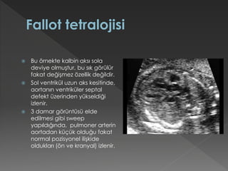  Bu örnekte kalbin aksı sola
deviye olmuştur, bu sık görülür
fakat değişmez özellik değildir.
 Sol ventrikül uzun aks kesitinde,
aortanın ventriküler septal
defekt üzerinden yükseldiği
izlenir.
 3 damar görüntüsü elde
edilmesi gibi sweep
yapıldığında, pulmoner arterin
aortadan küçük olduğu fakat
normal pozisyonel ilişkide
oldukları (ön ve kranyal) izlenir.
 