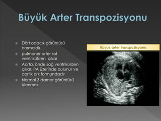  Dört odacık görüntüsü
normaldir.
 pulmoner arter sol
ventrikülden çıkar
 Aorta, önde sağ ventrikülden
çıkar, PA üzerinde bulunur ve
aortik ark formundadır
 Normal 3 damar görüntüsü
izlenmez
Büyük arter transpozisyonu
 