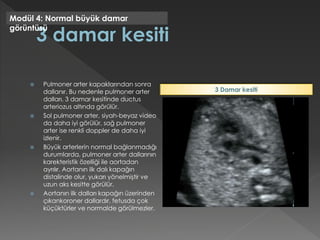  Pulmoner arter kapaklarından sonra
dallanır. Bu nedenle pulmoner arter
dalları, 3 damar kesitinde ductus
arteriozus altında görülür.
 Sol pulmoner arter, siyah-beyaz video
da daha iyi görülür, sağ pulmoner
arter ise renkli doppler de daha iyi
izlenir.
 Büyük arterlerin normal bağlanmadığı
durumlarda, pulmoner arter dallarının
karekteristik özelliği ile aortadan
ayrılır. Aortanın ilk dalı kapağın
distalinde olur, yukarı yönelmiştir ve
uzun aks kesitte görülür.
 Aortanın ilk dalları kapağın üzerinden
çıkankoroner dallardır, fetusda çok
küçüktürler ve normalde görülmezler.
Modül 4: Normal büyük damar
görüntüsü
3 Damar kesiti
 