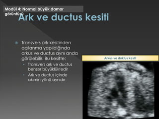  Transvers ark kesitinden
açılanma yapıldığında
arkus ve ductus aynı anda
görülebilir. Bu kesitte:
• Transvers ark ve ductus
benzer büyüklüktedir
• Ark ve ductus içinde
akımın yönü aynıdır
Modül 4: Normal büyük damar
görüntüsü
Arkus ve duktus kesiti
 