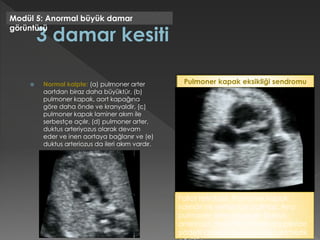  Normal kalpte: (a) pulmoner arter
aortdan biraz daha büyüktür, (b)
pulmoner kapak, aort kapağına
göre daha önde ve kranyaldir, (c)
pulmoner kapak laminer akım ile
serbestçe açılır, (d) pulmoner arter,
duktus arteriyozus olarak devam
eder ve inen aortaya bağlanır ve (e)
duktus arteriozus da ileri akım vardır.
Modül 5: Anormal büyük damar
görüntüsü
Fallot tetralojisi. Pulmoner kapak
kalındır ve serbestçe açılmaz. Ana
pulmoner arter dilatedir. Duktus
arteriozus görülmez. Renkli dopplerde
şiddetli derecede pulmoner yetmezlik
Pulmoner kapak eksikliği sendromu
 