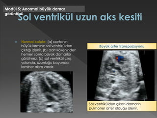  Normal kalpte: (a) aortanın
büyük kısmının sol ventrikülden
çıktığı izlenir, (b) aort kökeninden
hemen sonra büyük damarlar
görülmez, (c) sol ventrikül çıkış
yolunda, uzunluğu boyunca
laminer akım vardır.
Modül 5: Anormal büyük damar
görüntüsü
Sol ventrikülden çıkan damarın
pulmoner arter olduğu izlenir.
Büyük arter transpozisyonu
 