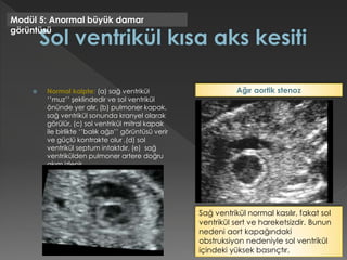  Normal kalpte: (a) sağ ventrikül
‘’muz’’ şeklindedir ve sol ventrikül
önünde yer alır, (b) pulmoner kapak,
sağ ventrikül sonunda kranyel olarak
görülür, (c) sol ventrikül mitral kapak
ile birlikte ‘’balık ağzı’’ görüntüsü verir
ve güçlü kontrakte olur ,(d) sol
ventrikül septum intaktdır, (e) sağ
ventrikülden pulmoner artere doğru
akım izlenir.
Modül 5: Anormal büyük damar
görüntüsü
Sağ ventrikül normal kasılır, fakat sol
ventrikül sert ve hareketsizdir. Bunun
nedeni aort kapağındaki
obstruksiyon nedeniyle sol ventrikül
içindeki yüksek basınçtır.
Ağır aortik stenoz
 