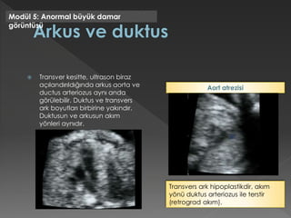  Transver kesitte, ultrason biraz
açılandırıldığında arkus aorta ve
ductus arteriozus aynı anda
görülebilir. Duktus ve transvers
ark boyutları birbirine yakındır.
Duktusun ve arkusun akım
yönleri aynıdır.
Modül 5: Anormal büyük damar
görüntüsü
Transvers ark hipoplastikdir, akım
yönü duktus arteriozus ile terstir
(retrograd akım).
Aort atrezisi
 