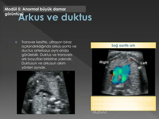 Transver kesitte, ultrason biraz
açılandırıldığında arkus aorta ve
ductus arteriozus aynı anda
görülebilir. Duktus ve transvers
ark boyutları birbirine yakındır.
Duktusun ve arkusun akım
yönleri aynıdır.
Modül 5: Anormal büyük damar
görüntüsü
Arkus aorta solda inerken orta hattı
çaprazlamaz, fakat trakea
etrafında, sağda, duktus ile bir daire
oluşturur.
Sağ aortik ark
 
