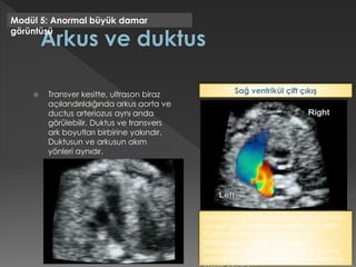  Transver kesitte, ultrason biraz
açılandırıldığında arkus aorta ve
ductus arteriozus aynı anda
görülebilir. Duktus ve transvers
ark boyutları birbirine yakındır.
Duktusun ve arkusun akım
yönleri aynıdır.
Modül 5: Anormal büyük damar
görüntüsü
Dekstrokardi. Aort pulmoner arter önünden
yükselir (yanlara dallanması ile ayrıt edilir).
Pulmoner atreziyi gösteren, duktus
arteriozus içinde ters akım vardır.
Normalden açıkça farklı olarak, 3 damar
görüntüsü sol el paneline benzer yerleşimli
Sağ ventrikül çift çıkış
 