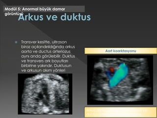  Transver kesitte, ultrason
biraz açılandırıldığında arkus
aorta ve ductus arteriozus
aynı anda görülebilir. Duktus
ve transvers ark boyutları
birbirine yakındır. Duktusun
ve arkusun akım yönleri
aynıdır.
Modül 5: Anormal büyük damar
görüntüsü
Arkus aorta, gestasyonel haftaya ve
ductus arteriozusa göre küçüktür.
Aort koarktasyonu
 