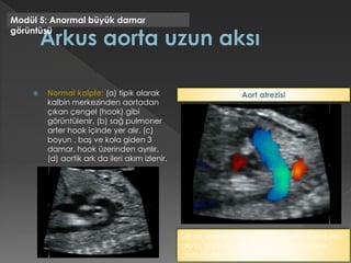  Normal kalpte: (a) tipik olarak
kalbin merkezinden aortadan
çıkan çengel (hook) gibi
görüntülenir, (b) sağ pulmoner
arter hook içinde yer alır, (c)
boyun , baş ve kola giden 3
damar, hook üzerinden ayrılır,
(d) aortik ark da ileri akım izlenir.
Modül 5: Anormal büyük damar
görüntüsü
Dilate ana pulmoner arter ve duktusda ileri
akım, transvers aortik ark üzerinde terse
akım izlenir.
Aort atrezisi
 