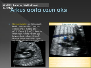  Normal kalpte: (a) tipik olarak
kalbin merkezinden aortadan
çıkan çengel (hook) gibi
görüntülenir, (b) sağ pulmoner
arter hook içinde yer alır, (c)
boyun , baş ve kola giden 3
damar, hook üzerinden ayrılır,
(d) aortik ark da ileri akım izlenir.
Modül 5: Anormal büyük damar
görüntüsü
Aortik arkda ileri akım ve bunun altında
ductus arteriozus içinde ters akım ile
birlikte görüldüğünde pulmoner atreziyi
işaret eder.
Pulmoner atrezi
 