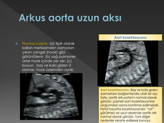  Normal kalpte: (a) tipik olarak
kalbin merkezinden aortadan
çıkan çengel (hook) gibi
görüntülenir, (b) sağ pulmoner
arter hook içinde yer alır, (c)
boyun , baş ve kola giden 3
damar, hook üzerinden ayrılır,
(d) aortik ark da ileri akım izlenir.
Aort koarktasyonu. Baş ve kola giden
damarların bağlantısında ufak bir açı
farkı, aortik ark paterni normal olarak
görülür, şüpheli aort koarktasyonları
doğumdan sonra konfirme edilmelidir.
Fetal hayatta koarktasyonda ‘’raf’’
görülmez ve uzun eksende aortik ark
normal olarak görülür. Tanı diğer
nedenler ekarte edilerek konulur.
Aort koarktasyonu
 
