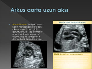  Normal kalpte: (a) tipik olarak
kalbin merkezinden aortadan
çıkan çengel (hook) gibi
görüntülenir, (b) sağ pulmoner
arter hook içinde yer alır, (c)
boyun , baş ve kola giden 3
damar, hook üzerinden ayrılır,
(d) aortik ark da ileri akım izlenir.
Büyük damarların transpozisyonu. Duktusa
uzun aks ile bakıldığında normal görüntü
izlenmez. Bunun yerine, büyük damarlar
paralel olarak yükselir, aorta (başa dal
verdiğinden ayırt edilir) sağ ventrikülden,
pulmoner arterde önde sol ventrikülden
doğar.
Büyük arter transpozisyonu
 