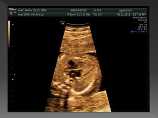 TEMEL FETAL KARDİYAK İNCELEME 