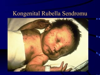 Kongenital Rubella Sendromu




                              14
 