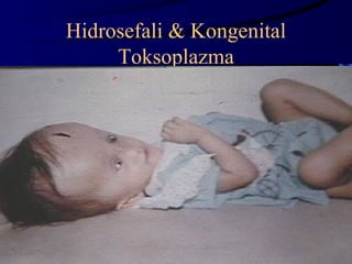 Hidrosefali & Kongenital
     Toksoplazma




                           24
 