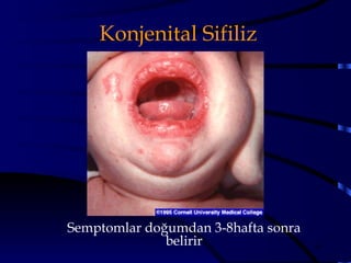 Konjenital Sifiliz




Semptomlar doğumdan 3-8hafta sonra
              belirir                40
 