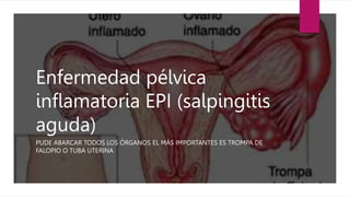 Enfermedad pélvica
inflamatoria EPI (salpingitis
aguda)
PUDE ABARCAR TODOS LOS ÓRGANOS EL MÁS IMPORTANTES ES TROMPA DE
FALOPIO O TUBA UTERINA
 