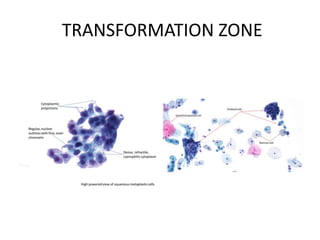TRANSFORMATION ZONE
 