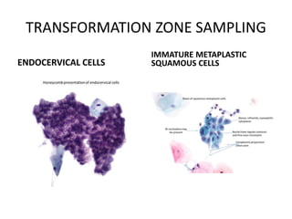 TRANSFORMATION ZONE SAMPLING
ENDOCERVICAL CELLS
IMMATURE METAPLASTIC
SQUAMOUS CELLS
 