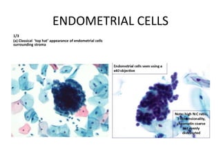 ENDOMETRIAL CELLS
1/3
(a) Classical ‘top hat’ appearance of endometrial cells
surrounding stroma
 