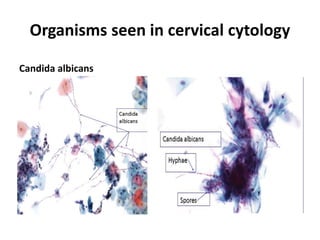 Organisms seen in cervical cytology
Candida albicans
 