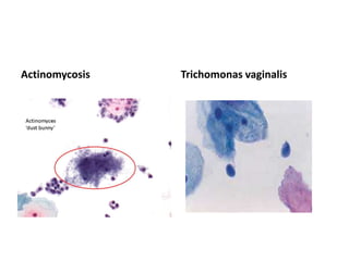 Actinomycosis Trichomonas vaginalis
 