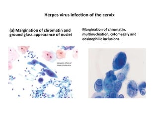 Herpes virus infection of the cervix
(a) Margination of chromatin and
ground glass appearance of nuclei
Margination of chromatin,
multinucleation, cytomegaly and
eosinophilic inclusions.
 