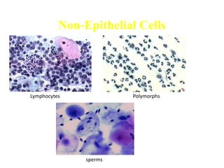 Non-Epithelial Cells
sperms
Lymphocytes Polymorphs
 