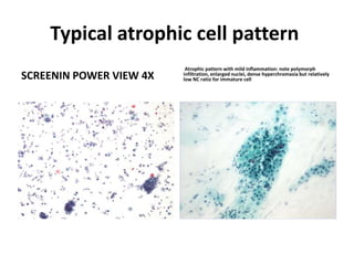 Typical atrophic cell pattern
SCREENIN POWER VIEW 4X
Atrophic pattern with mild inflammation: note polymorph
infiltration, enlarged nuclei, dense hyperchromasia but relatively
low NC ratio for immature cell
 