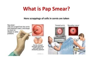 What is Pap Smear?
Here scrappings of cells in cervix are taken
 