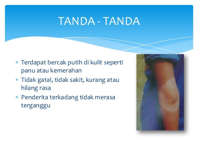 Ayo cegah kusta Ayo cegah kusta