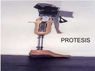 PROTESIS
 