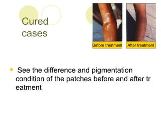 Cured  cases ,[object Object],Before treatment After treatment 