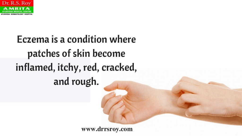 Ayurvedic Treatment For Eczema In Kochi Ayurvedic Skin Hospital In Kerala