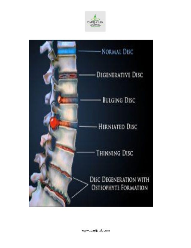 Best Ayurvedic Treatment For Disc Bulge In Kerala Ayurvedic treatment of cervical disc bulge