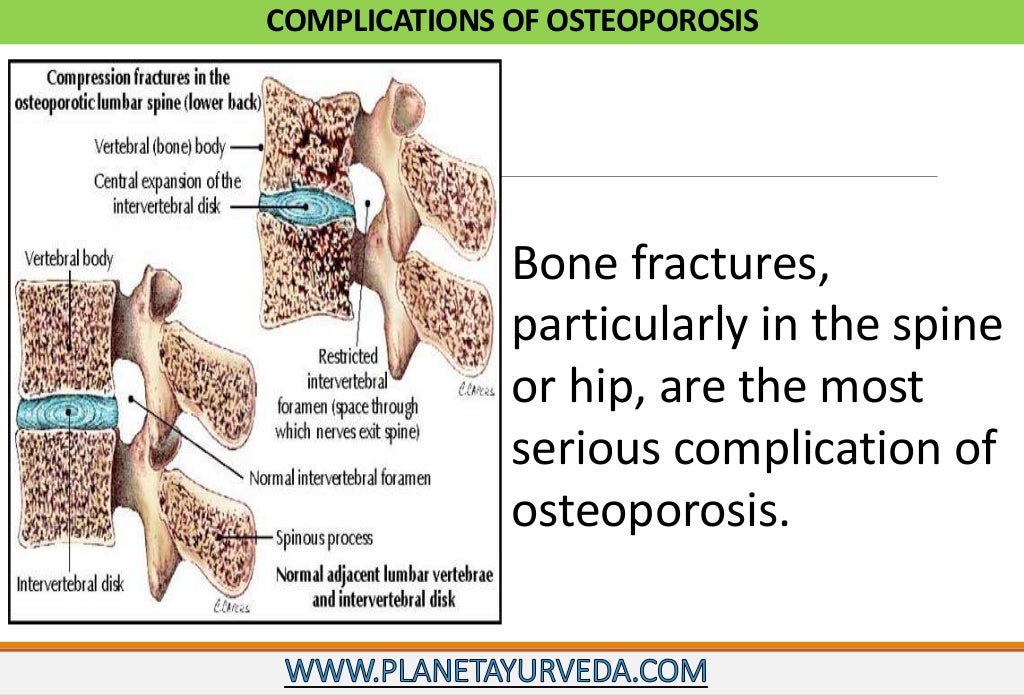 Ayurvedic treatment of osteoporosis