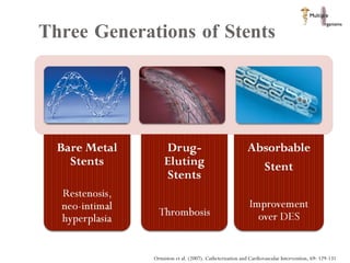 Three Generations of Stents  Ormiston et al. (2007). Catheterization and Cardiovascular Intervention, 69: 129-131 