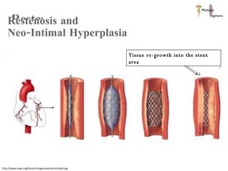 Restenosis  http://www.evgn.org/home/imagesnew/stentv2web.jpg Restenosis and  Neo-Intimal Hyperplasia  Tissue re-growth into the stent area 