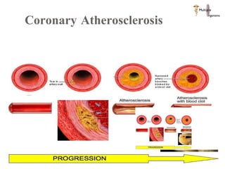 Coronary Atherosclerosis 