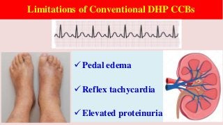 Limitations of Conventional DHP CCBs
Pedal edema
Reflex tachycardia
Elevated proteinuria
 