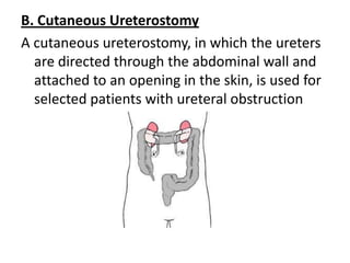 B. Cutaneous Ureterostomy
A cutaneous ureterostomy, in which the ureters
are directed through the abdominal wall and
attached to an opening in the skin, is used for
selected patients with ureteral obstruction

 