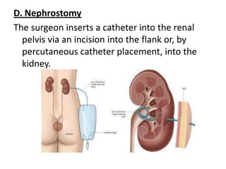 D. Nephrostomy
The surgeon inserts a catheter into the renal
pelvis via an incision into the flank or, by
percutaneous catheter placement, into the
kidney.

 