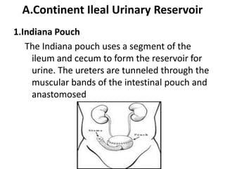 A.Continent Ileal Urinary Reservoir
1.Indiana Pouch
The Indiana pouch uses a segment of the
ileum and cecum to form the reservoir for
urine. The ureters are tunneled through the
muscular bands of the intestinal pouch and
anastomosed

 