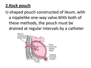 2.Kock pouch
U-shaped pouch constructed of ileum, with
a nipplelike one-way valve.With both of
these methods, the pouch must be
drained at regular intervals by a catheter

 