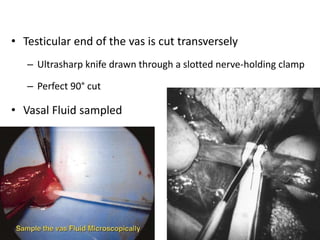 • Testicular end of the vas is cut transversely
– Ultrasharp knife drawn through a slotted nerve-holding clamp
– Perfect 90° cut
• Vasal Fluid sampled
 
