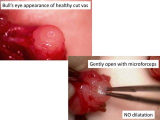 Bull’s eye appearance of healthy cut vas
Gently open with microforceps
NO dilatation
 