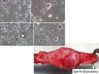 Sperm Granuloma
 